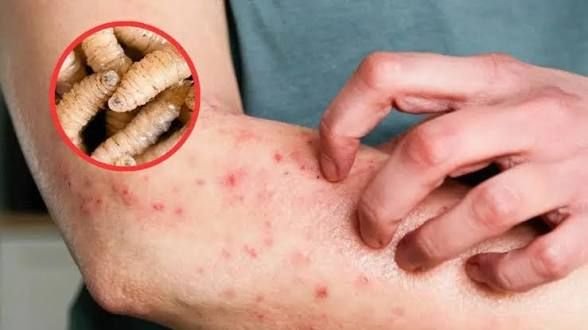 Campeche suma nueve casos de miasis humana