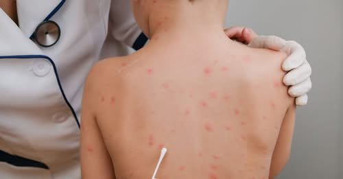 Repuntan varicela e infecciones respiratorias en Campeche durante temporada vacacional