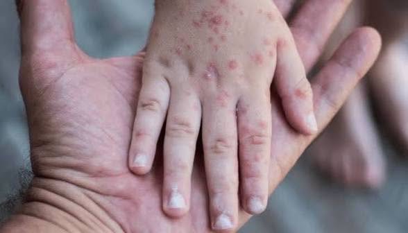 Campeche suma 11 casos de sarampión en 2026; contagios siguen en aumento