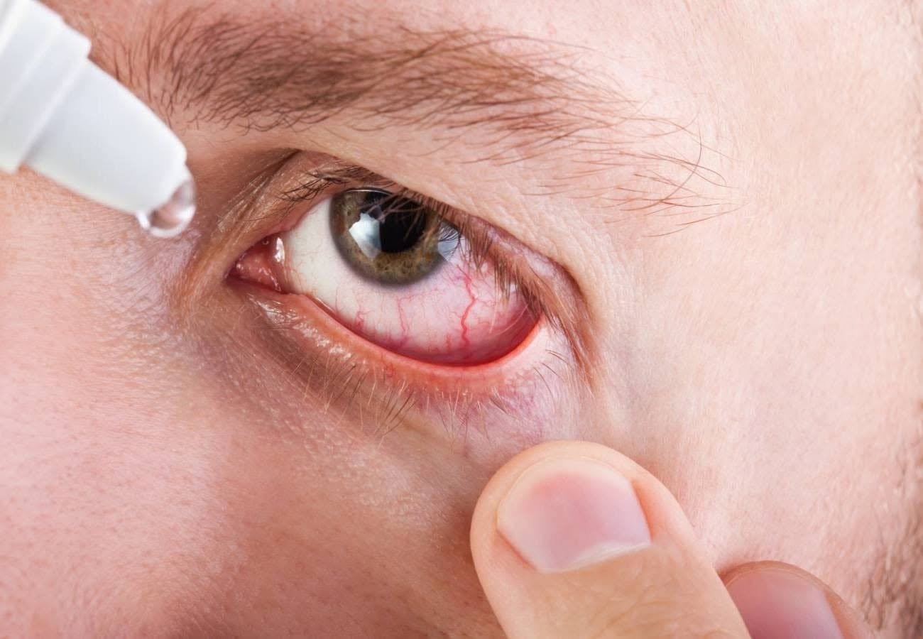 Hasta 60% aumentan casos de conjuntivitis por el calor